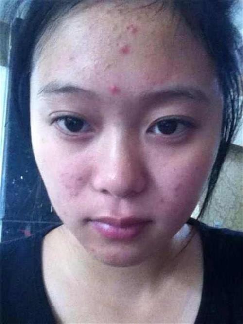 玩手机游戏爆痘_玩手机的游戏_玩手机对痘痘影响大吗