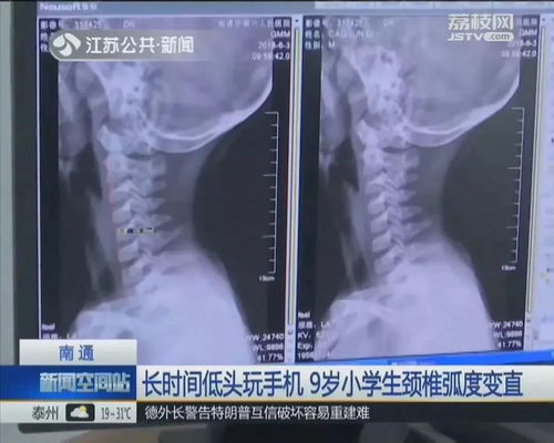 游戏颈椎,揭秘电子竞技时代下的健康危机(图1) 游戏颈椎,揭秘电子竞技时代下的健康危机(图1)