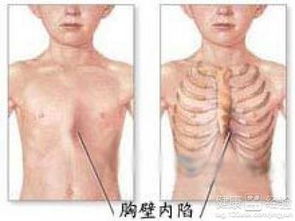 挠肋骨游戏,锻炼身体两不误(图1)
